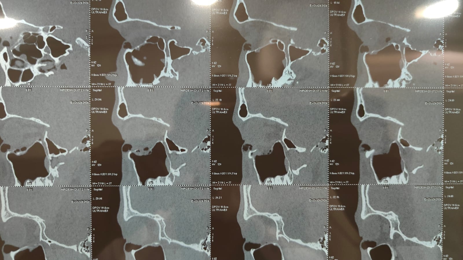 CT scan showing blow out fracture